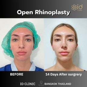 before-after photo rhinoplasty-nose-job