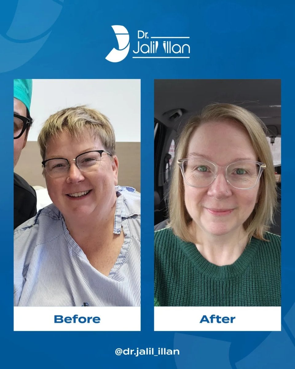 Resultados de lifting facial antes y después en Dr. Jalil Illan – rejuvenecimiento facial