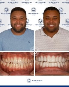 before-after photo dental-bonding