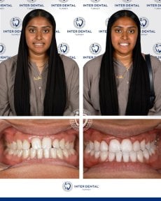 before-after photo dental-bonding