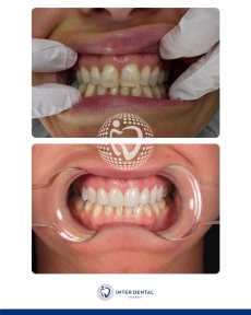 before-after photo dental-bonding