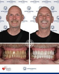 before-after photo dental-bonding