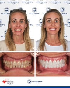 before-after photo dental-bonding