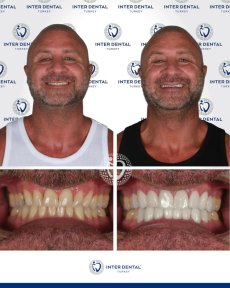 before-after photo emax-veneers