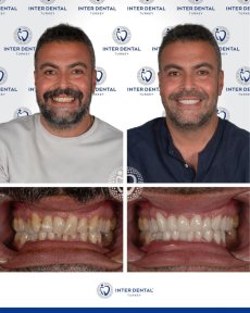 before-after photo emax-veneers