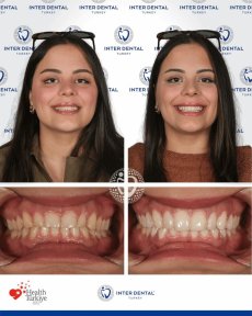 before-after photo emax-veneers