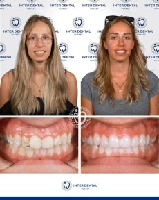 before-after photo emax-veneers