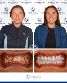 before-after photo dental-crown-installation