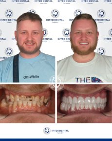 before-after photo dental-crown-installation