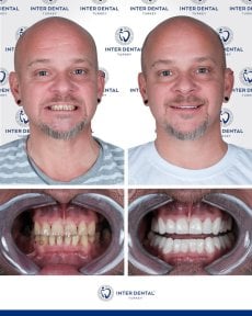 before-after photo dental-crown-installation