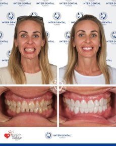 نتائج قبل وبعد ترابط الأسنان في Inter Dental Turkey، ابتسامة محسنة وأسنان أكثر بياضًا