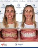 نتائج قبل وبعد ترابط الأسنان في Inter Dental Turkey، ابتسامة محسنة وأسنان أكثر بياضًا