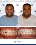 نتائج قبل وبعد تجميل الأسنان بالترابط في Inter Dental Turkey – ابتسامة محسنة وأسنان أكثر بياضًا