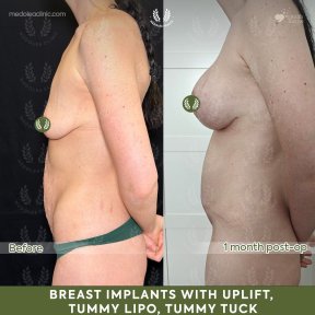 before-after photo abdominoplastika