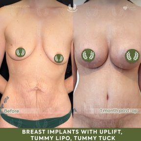 before-after photo abdominoplastika