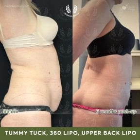 before-after photo abdominoplastika