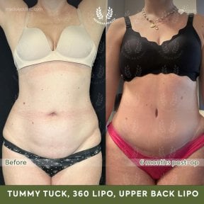 before-after photo abdominoplastika