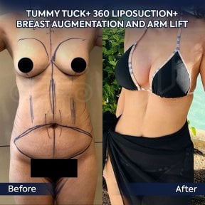 before-after photo abdominoplastika