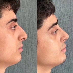 before-after photo revision-rhinoplasty
