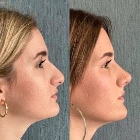before-after photo revision-rhinoplasty