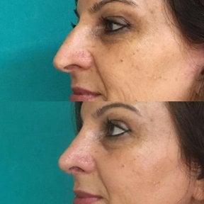 before-after photo revision-rhinoplasty