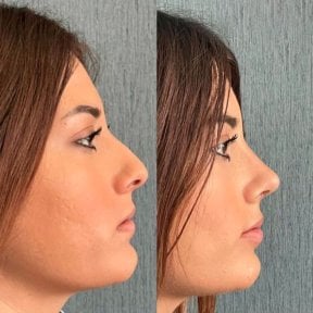 before-after photo revision-rhinoplasty