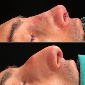 before-after photo revision-rhinoplasty