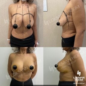 before-after photo nipple-correction