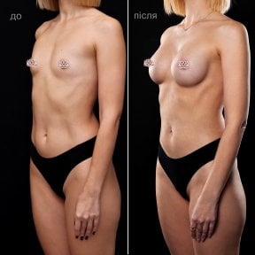 before-after photo uvelicenie-grudi