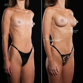 before-after photo uvelicenie-grudi