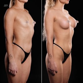 before-after photo uvelicenie-grudi
