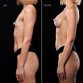 before-after photo uvelicenie-grudi