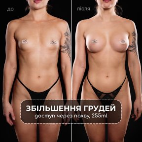 before-after photo uvelicenie-grudi