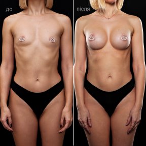 before-after photo uvelicenie-grudi