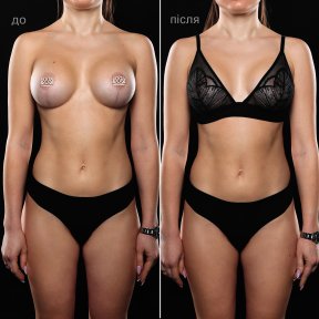 before-after photo mastopexy-breast-lift-contour-plastics