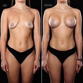 before-after photo mastopexy-breast-lift-contour-plastics