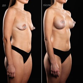before-after photo mastopexy-breast-lift-contour-plastics