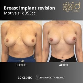 before-after photo breast-lift-with-implants-round