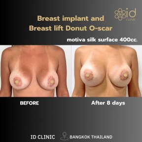 before-after photo breast-lift-with-implants-round