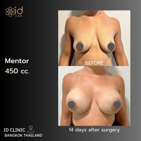 before-after photo breast-lift-with-implants-round
