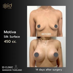 before-after photo breast-lift-with-implants-round