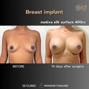 before-after photo breast-lift-with-implants-round