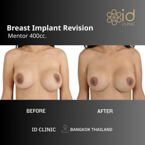 before-after photo breast-lift-with-implants-round
