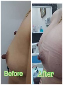 before-after photo breast-augmentation