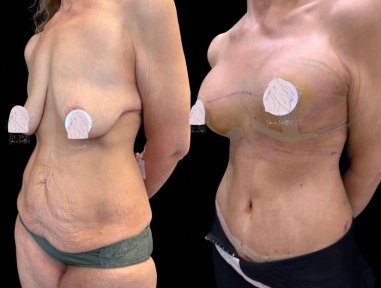 before-after photo breast-implant-revision