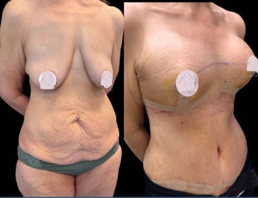 before-after photo breast-implant-revision