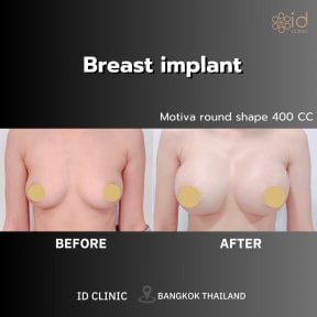 before-after photo breast-augmentation