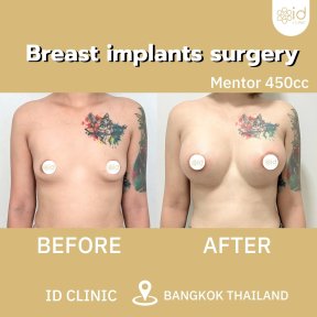 before-after photo breast-augmentation