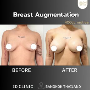 before-after photo breast-augmentation