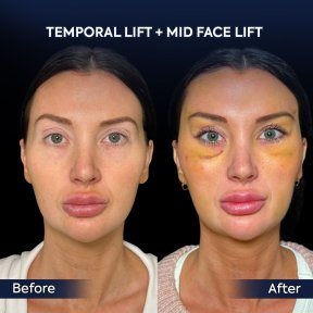 before-after photo lipomodelirovanie-lica